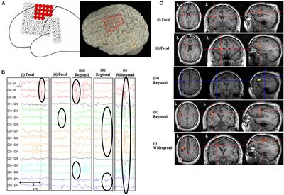 Mapping Epileptic Networks Using Simultaneous Intracranial EEG-fMRI